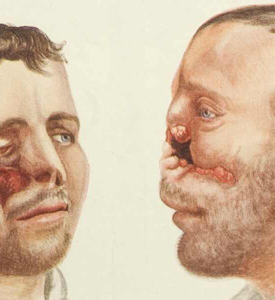 H.P. Pickerill'in Yüz Ameliyatı kitabından, 1924 / Wellcome Images